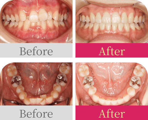 前歯のガタガタ