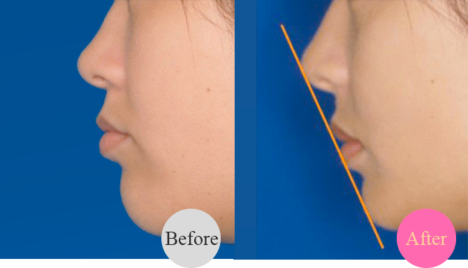 Eライン/スマイルラインの改善