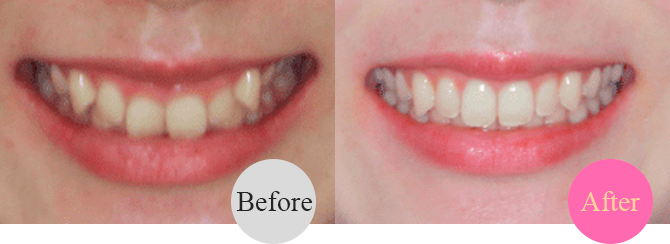 ガミースマイルの改善