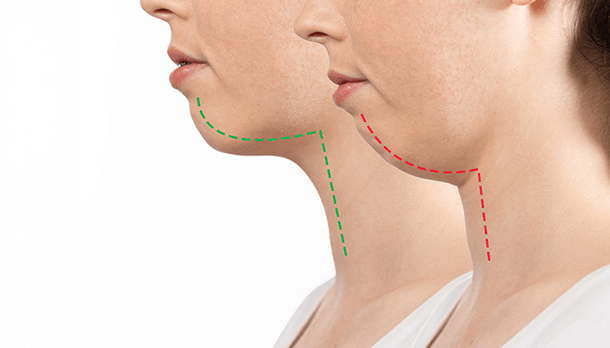 アデノイド顔貌