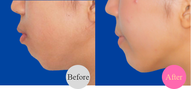 アデノイド顔貌の改善