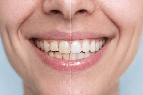 歯の黄ばみ（ホワイトニング併用）